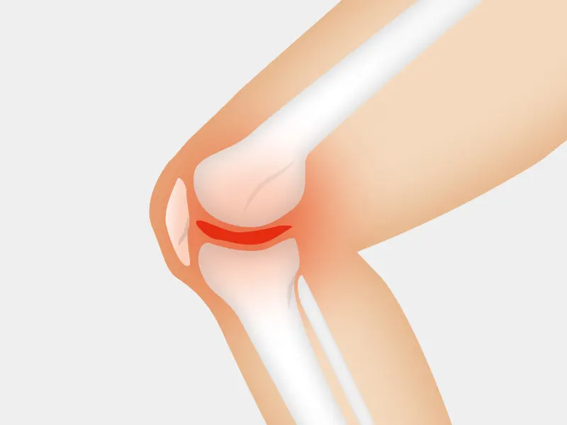 centro broussais artrosi lombalgia cervicalgia