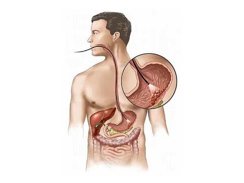 centro broussais gastrite ulcera